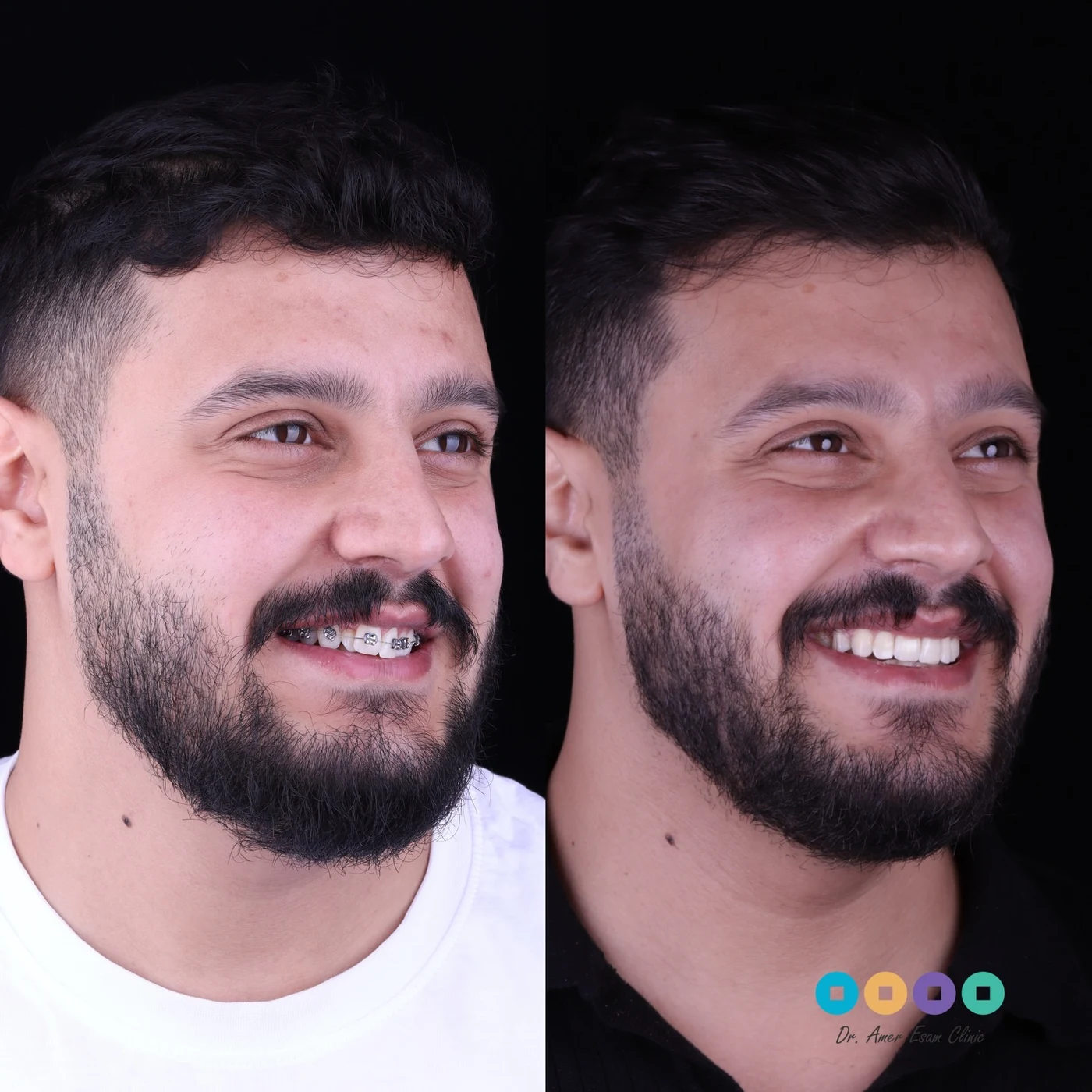 نتيجة تقويم وتجميل الابتسامة دكتور عامر عصام