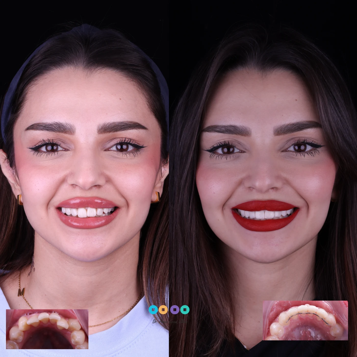 تجميل وتبييض الابتسامة فينير