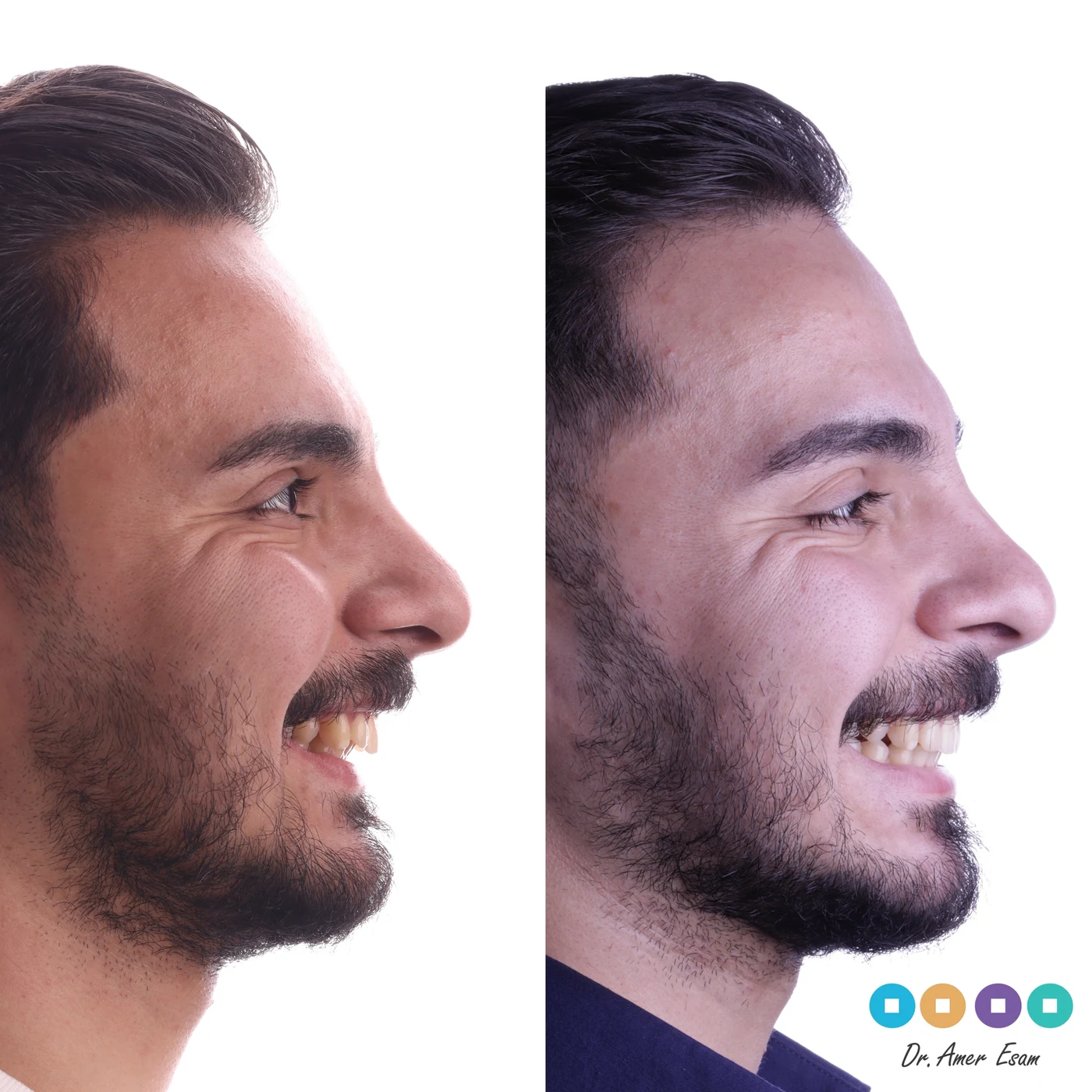 تعديل الإطباق وبروفايل الفك